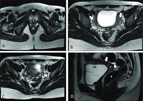 Mri Of Pelvis T2 Weighted Tse Images Axial A At The Level Of