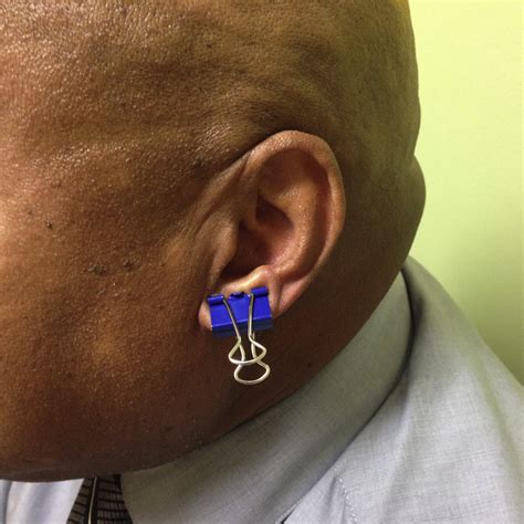 Binder Clips In The Treatment Of Auricular Keloids Journal Of The