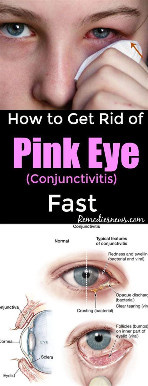 How To Get Rid Of Pink Eye Conjunctivitis Beautyhealth