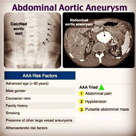 Emt Student In Training — Resuscitationist An Abdominal Aortic Aneurysm
