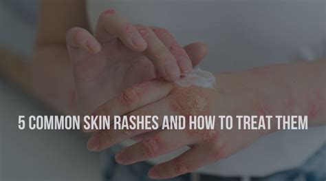 5 Common Skin Rashes And How To Treat Them Dermatrichs Clinic Kanpur
