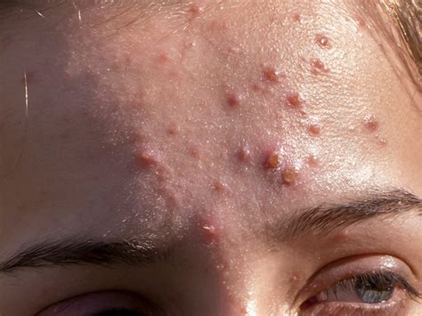 Inflamed Acne Treatments And Prevention