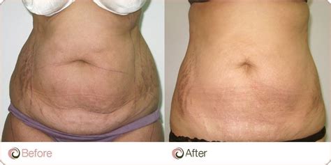 How To Tighten Loose Skin After Losing Weight Cosmos Aesthetics