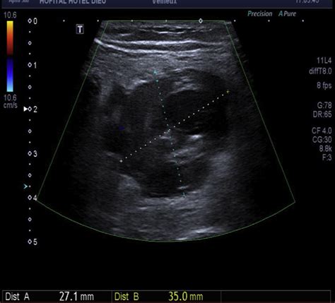 Ultrasound Image Of The Popliteal Venous Aneurysm Pva Download