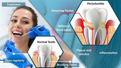 Periodontitis Gum Disease Symptoms Treatment And Prevention