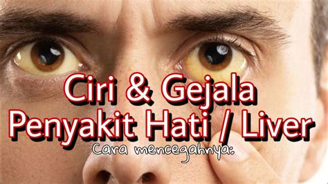 Jun 30, 2021 · tak lama sejak kedatangan model berparas anyar 4er, bmw group indonesia segera melengkapi eksistensinya dengan kontestan performa tinggi. Ciri dan gejala penyakit Liver || Cara pencegahannya ...