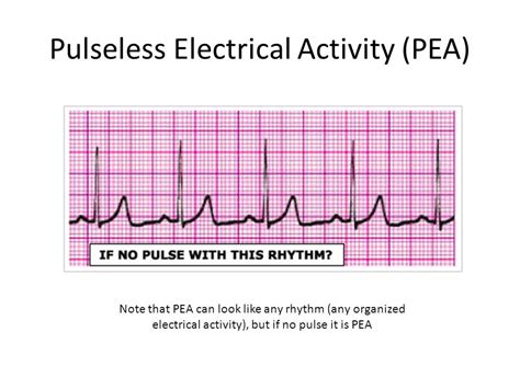 pulseless electrical activity pea diagram quizlet