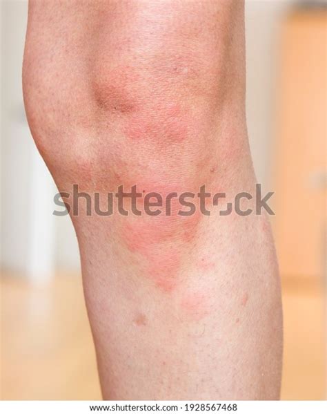 Hives Urticaria Skin Condition Red Skin Stock Photo Edit Now 1928567468