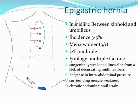 Ppt Hernia Powerpoint Presentation Free Download Id2957512