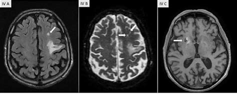 Brain Mri T2 Flair Diffusion And T1 Sequences Demonstrating Multiple