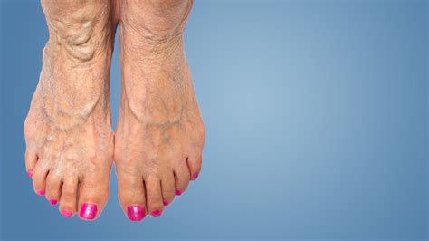 Remove Varicose Abnormal Veins In Feet Ankle Legs Thighs