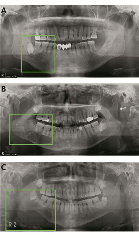 Examples Of The Included Lesions A Dentigerous Cyst B Odontogenic