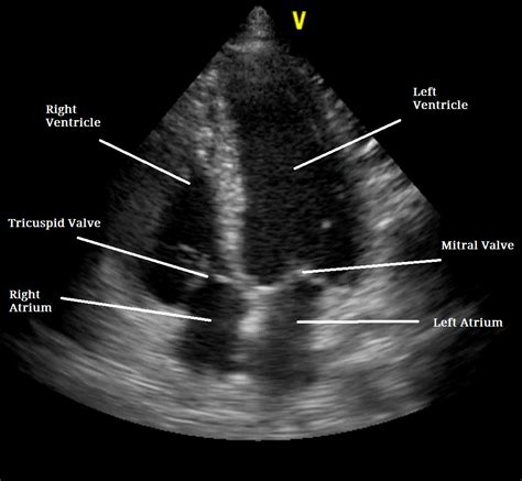 What Is An Echocardiogram Test