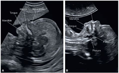 The Fetal Face And Neck Radiology Key