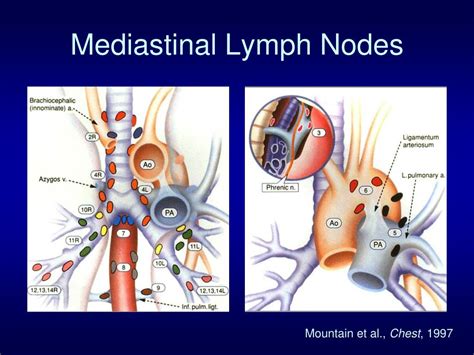 What Are Mediastinal Lymph Nodes All In One Photos