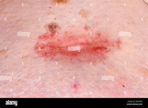 Umbilical Psoriasis Close Up Of Psoriasis Affecting The Skin Around