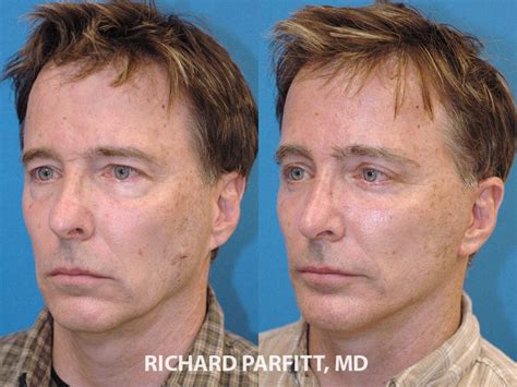 Male Plastic Surgery Before And After Photos