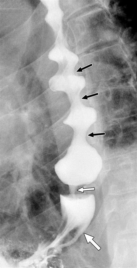 Diffuse Esophageal Spasm CT Findings In Seven Patients AJR