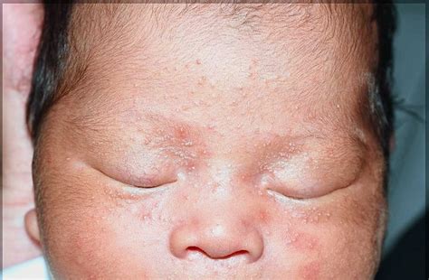 Risk Of Newborn Baby And Rash Search Bd Doctors