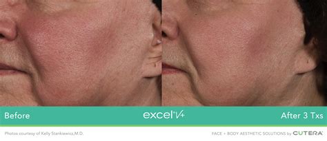 Excel® V Laser By Cutera Peraza Dermatology Group