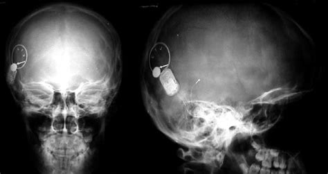 ⊞ grid view ⊟ list view. X-ray skull AP and lateral views displaying the magnet ...