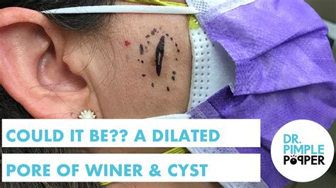 Could It Be A Dilated Pore Of Winer And Cyst Recently Added Dr