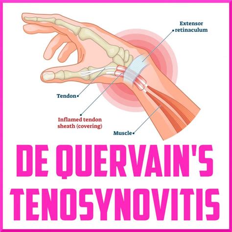 Treatment Options For De Quervains Tenosynovitis Sports Medicine Review