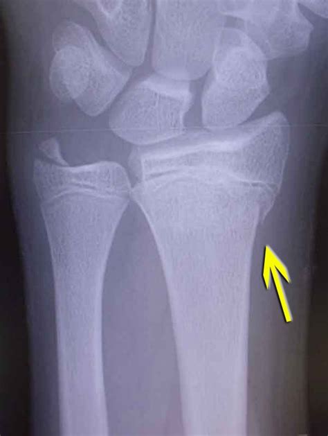 Buckle Fracture Causes Symptoms And Treatment