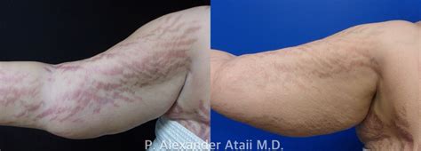 Stretch Mark Removal Before And After Stretchm