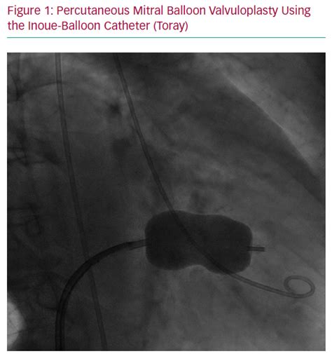 Percutaneous Mitral Balloon Valvuloplasty Using The Inoue Balloon Catheter Toray Radcliffe