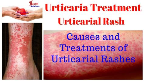 Urticaria Treatment Urticarial Rash Causes And Treatments Of