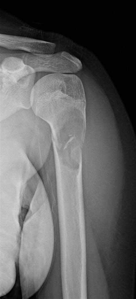 Unicameral Bone Cyst Image