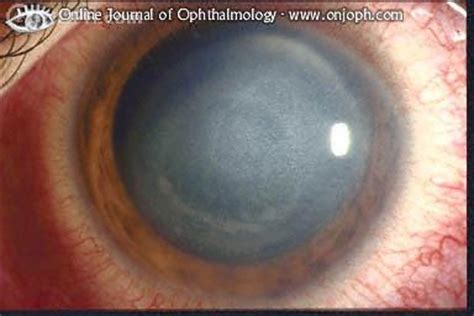 Treatment of hsv stromal keratitis is considerably more controversial than treatment of hsv epithelial disease. Atlas of Ophthalmology