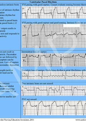 Cardiac Arrhythmia Reference Chart PDF Cardiovascular Nursing