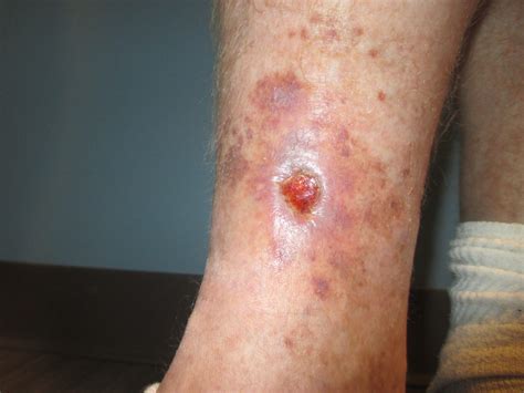 Treatment For Venous Stasis Ulcers In Beaumont Tx Vascare