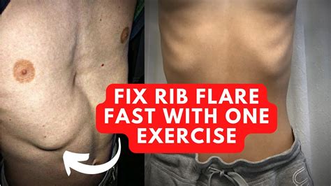 how to fix rib flare with this 1 powerful exercise youtube