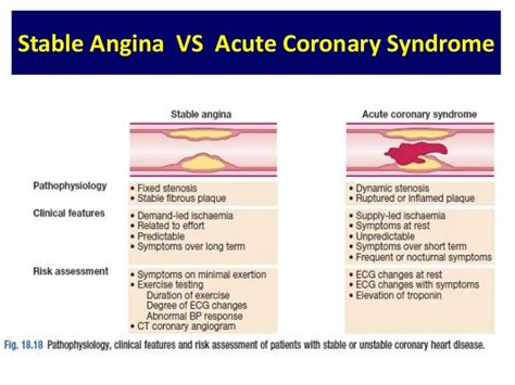 Stable Angina Vs Acute Coronary Syndrome Monica Benjamin Pa S