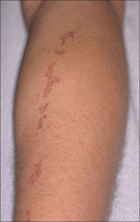 Linear Porokeratosis Dermatology Jama Dermatology