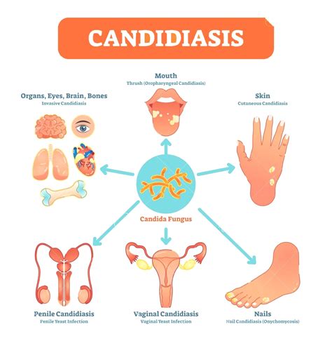 Core Naturopathics Candida Treatment Success With Ozone Therapy