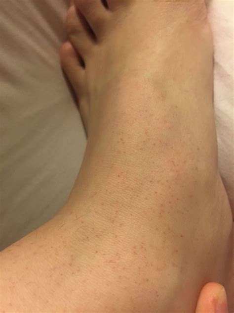 Skin Concern These Tiny Red Dots On The Top Of My Feet And Up My Legs
