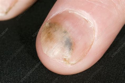 Fungal Nail Infection Stock Image C0016623 Science Photo Library