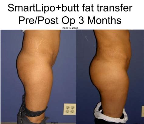 Fat Transfer Before And After Gallery Paramus Nj Bergen Aesthetics