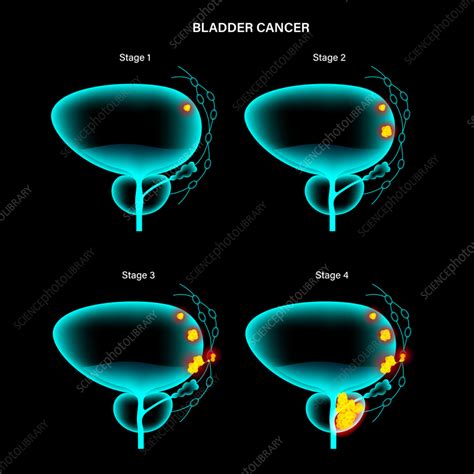 Bladder Cancer Stages Illustration Stock Image F0357142 Science
