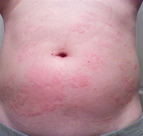 Category Hives Kirkland Ultra Free And Clear Rash