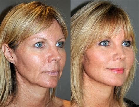 Laser Tightening Southern Cosmetic Laser Charleston Botox Massage