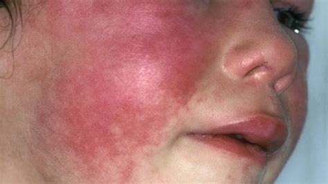 Can Adults Get Scarlet Fever Symptoms Of The Strep A Rash Explained