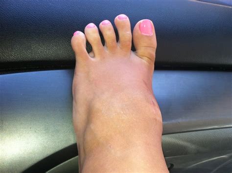 Sometimes, they can appear on the top of the foot and become visible through the skin. meibimusings: Jenna surgery - July 23 - update