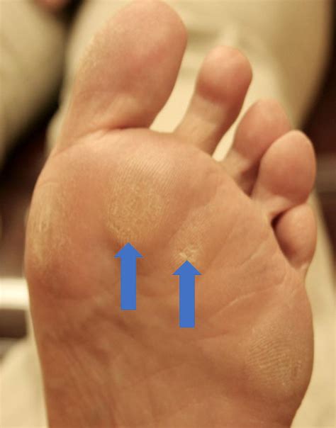 Ball Of The Foot • Plantar Fasciitis Md