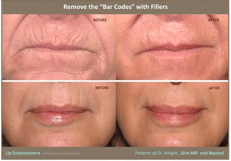 Lip Linesborders Cosmetic Skin Care Specialist Plano Tx