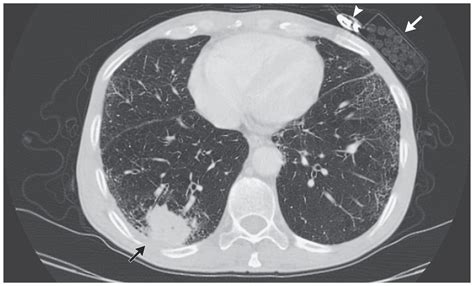 Squamous Cell Carcinoma Of The Lung Physical Examination Grepmed